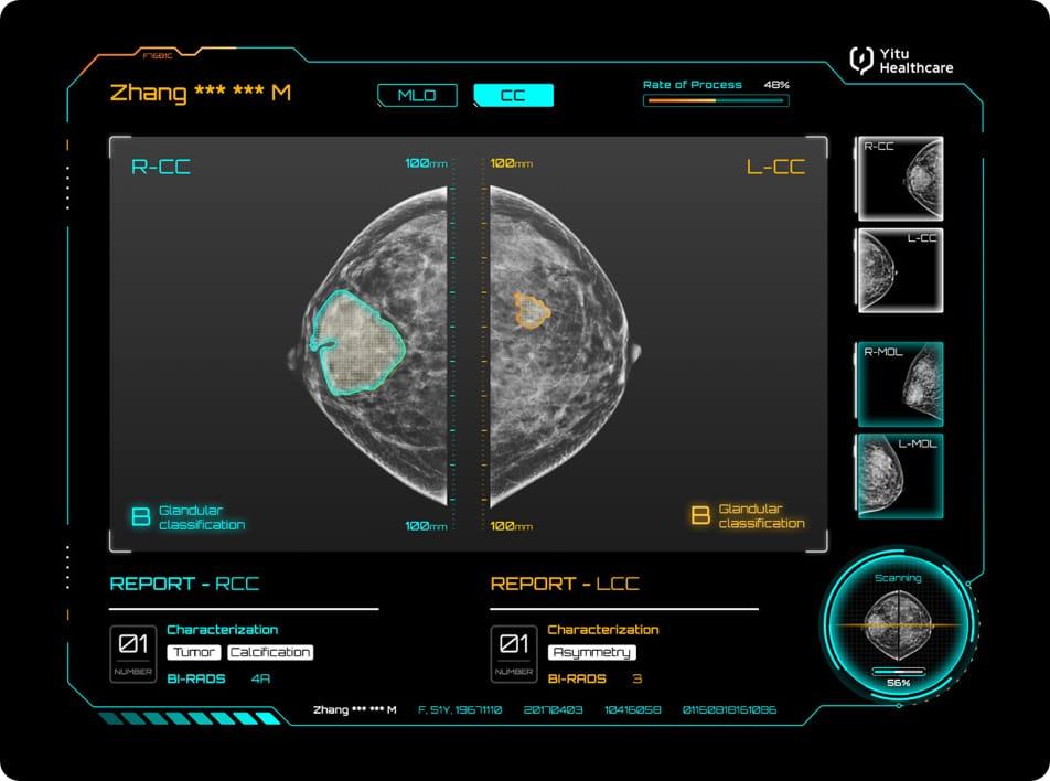 care.aiTM 乳腺X線(xiàn)智能診斷系統(tǒng)
